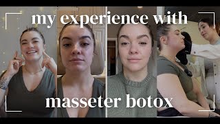 MY EXPERIENCE WITH MASSETER BOTOX for my TMJD  come get botox with me  a chat about skincare [upl. by Eerbua285]