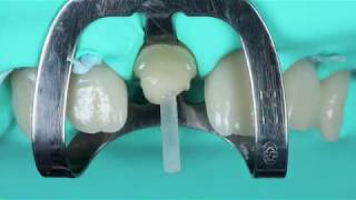 Post Cementation and Core BuildUp Using LuxaCore Z Dual [upl. by Rafa348]