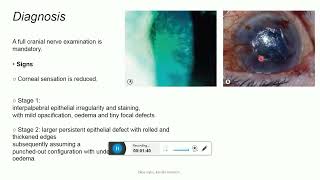 Neurotrophic keratopathy [upl. by Anaert]