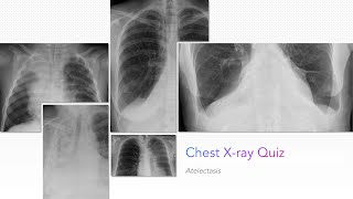 Chest Xray Quiz Atelectasis [upl. by Hunfredo]