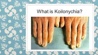 WHAT TO KNOW ABOUT KOILONYCHIA  NAIL DEFORMITIES  CLINICAL MEDICINE  MBBS REVISION GUIDE [upl. by Nallaf]