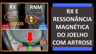 RX E RESSONÂNCIA MAGNÉTICA DO JOELHO COM ARTROSE [upl. by Haraz]