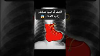 اكتشاف طبي قلب انسان علي شكل حذاء explore اكسبلور doctor معلومات reels memes shorts تعلم [upl. by Ayaros]