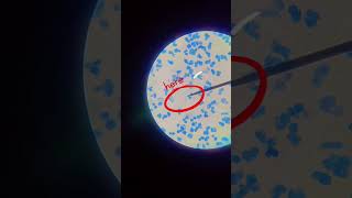 Mycobacterium tuberculosis in acid fast bacilli 🦠 [upl. by Dihgirb930]