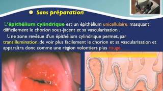 Colposcopie Ectropion et sa réparation point de départ des dysplasies du col colposcopy [upl. by Bate]