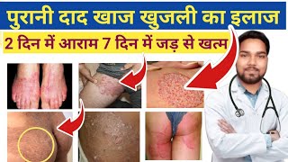 जांघों की दाद खाज खुजली खत्म  Home Remedies For Itching in Private Parts  Fungal infection [upl. by Areehs]