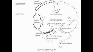 Herniation amp Intracranial Hemorrhage  Draw it to Know it Neuroanatomy [upl. by Nassir]