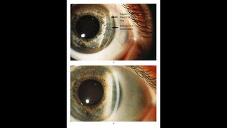 Kayser Fleischer Ring bei Patient mit Morbus Wilson [upl. by Adnoel]