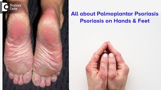 All about Palmoplantar Psoriasis  Psoriasis on hands amp feet  Dr Rajdeep Mysore  Doctors Circle [upl. by Auos631]