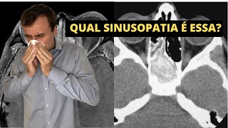 SINUSITE AGUDA CRÔNICA ALÉRGICA FÚNGICA Como a radiologia pode diferenciar na tomografia [upl. by Ehttam390]