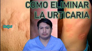 COMO ELIMINAR LA URTICARIA  RONCHAS [upl. by Dhaf174]