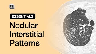 Nodular Interstitial Patterns  Chest Radiology Essentials [upl. by Acimot]