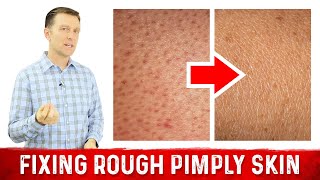 What Does Rough Pimply Skin Chicken Skin or KERATOSIS PILARIS Mean – Dr Berg [upl. by Haakon334]