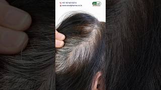 Homeopathic Medicine for Hair Problems shorts hairfall hairgreying homeopathyasitis [upl. by Mcdade]