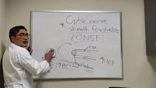 Optic Nerve Sheath Fenestration [upl. by Purcell]