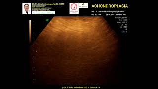 Achondroplasia [upl. by Anib]