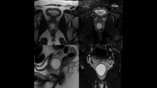 Mri prostate for 29 y patient [upl. by Eniamrahs12]