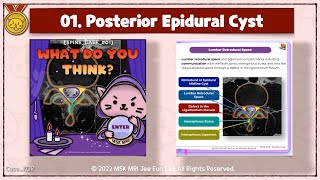 01 Epidural cysts associated with Baastrups Disease interspinous bursitis retrodural space [upl. by Atinhoj]