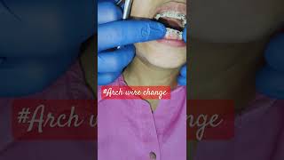 orthodontistorthowirechange orthodonticsbraces orthoshortssmilemakeover smiledentistdentist [upl. by Bebe]