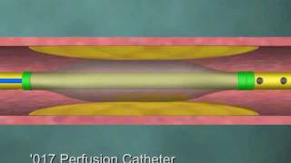 Medical Videos Perfusion Catheter  Demonstratives  ESi [upl. by Annai]