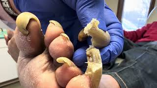 Unbelievable Toenails so long and painful that patient cannot walk [upl. by Saire]