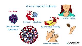 What is Chronic myeloid leukemia [upl. by Guenna38]