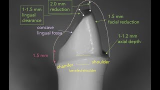 Anterior PFM Preparation  Dr Richard Stevenson [upl. by Grobe]