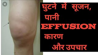 Swelling  edema effusion in Knee joint Hindi  घुटने में पानी भरना सूजन का इलाज knee pain ACL [upl. by Reldnahc]