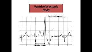 ECG course Ectopics in ECG Dr Sherif Altoukhy [upl. by Anderson]