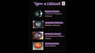 Types of Cataract fmge ophthalmology Mnemonic [upl. by Ezarra]