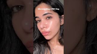 Microneedling  PRP vlog [upl. by Maril]