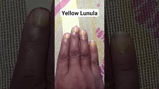 Yellow Lunula Chand 🌒 Sings in Hand Palmistry Dikki astrology palmistry astrology motivation [upl. by Ikkela]