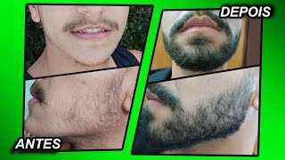 2 ANOS USANDO MINOXIDIL Kirkland e foligain [upl. by Radloff804]