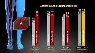 Avinger Lumivascular Explainer Animation [upl. by Virginie26]