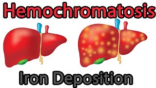 Hemochromatosis Easy explained symptoms causes treatment prognosis [upl. by Etnoved]