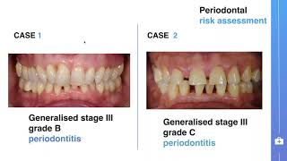 Symposium on stage IIII periodontitis treatment guideline  Yaman Altaep from Liège [upl. by Abbot771]