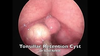 Tonsillar Retention Cyst  Incision and Drainage  Dr Sunil Kewat [upl. by Anam]