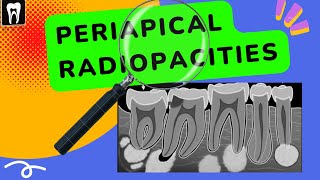 Periapical lesions  Periapical radiopacities  Oral radiology Apical radiopacities [upl. by Anahgem]