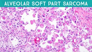 Alveolar soft part sarcoma explained in 5 minutes basic soft tissue pathology [upl. by Ainitsirhc]