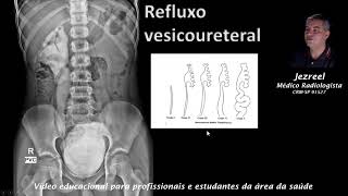 Refluxo vesico ureteral [upl. by Gabler644]