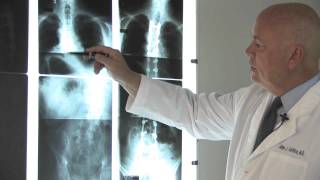 Scoliosis Treatment Options for Children and Adults  El Camino Health [upl. by Vaughan]