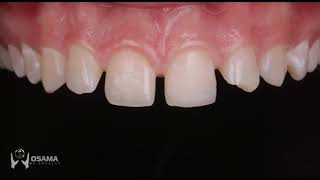 Smile makeover with direct veneers and simple managment of multiple diastema [upl. by Haerr]