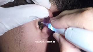 Mans MASSIVE Earwax Softened and Removed with Hydrogen Peroxide [upl. by Dieterich758]