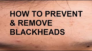 HOW TO PREVENT  REMOVE BLACKHEADS [upl. by Yelats209]