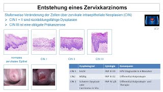 Entstehung eines Zervixkarzinoms  Strahlentherapie Prof Hilke Vorwerk [upl. by Archibaldo454]