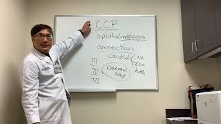 Ophthalmoplegia of Carotid Cavernous Fistula [upl. by Chud536]