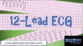 12 Lead ECG Quiz  MI Mimics and Sgarbossas Criteria [upl. by Jarlath]