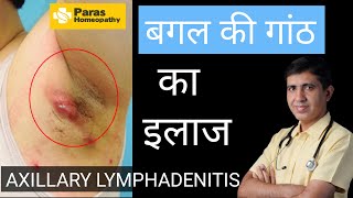 बगल की गाँठ  Axillary Lymphadenitis  Armpit Lymph Nodes Swollen  Swollen Lymph Nodes Treatment [upl. by Rourke]