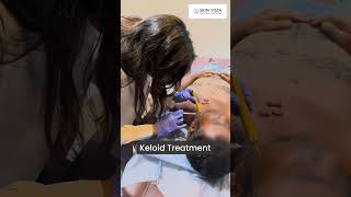 Keloid injections procedure for Keloid treatment keloidtreatment keloidremoval keloids [upl. by Reiser]