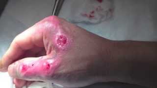 2nd degree burn vlog no3 healing process [upl. by Fesoy]